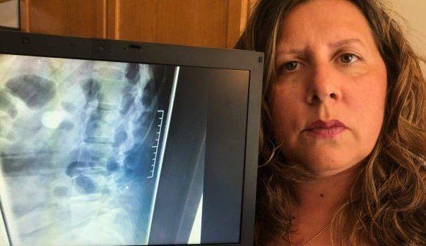 امرأة من أونتاريو تكتشف وجود إبرة في عمودها الفقري بعد 16 عاماً من الولادة