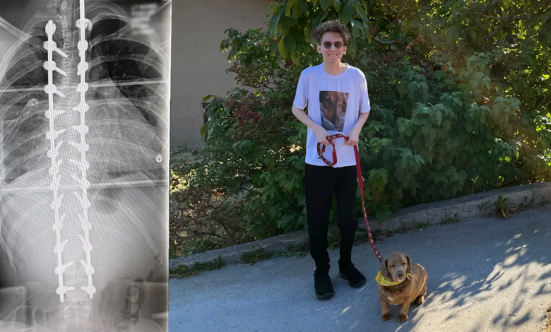 على اليسار صورة أشعة للعمود الفقري لـ Cael بعد العملية الجراحية وعلى اليمين صورة Cael مع كلبه