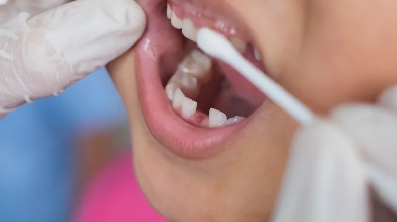 ميزة رعاية الأسنان تصبح قانونا رسميا في كندا.. وإليك كل ما تريد معرفته عنها