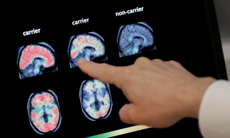 فحص الدماغ من خلال صور الرنين المغناطيسي لتحديد الإصابة بمرض الزهايمر