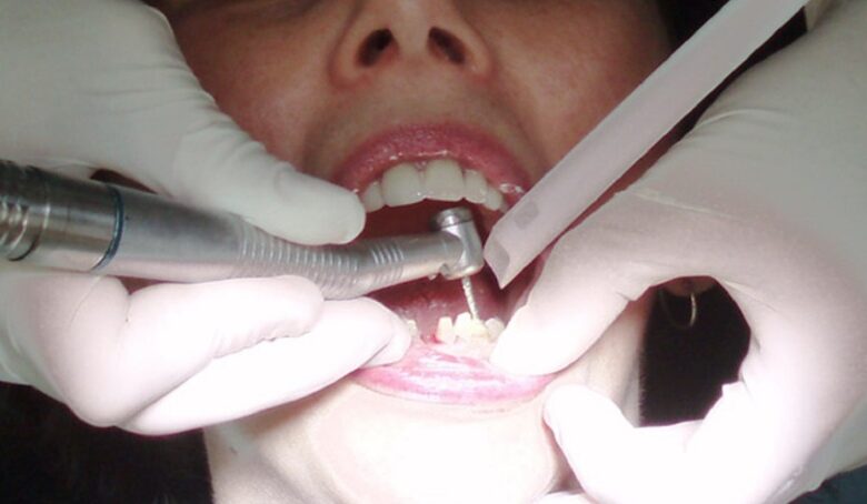 كيبيك ستطلب الانسحاب من برنامج تغطية رعاية الأسنان الفيدرالي والحصول على تعويض