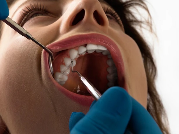 امرأة تقاضي طبيب أسنان بعدما أجرى لها 32 عملية في زيارة واحدة فقط